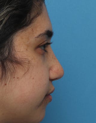 Rhinoplasty Before & After Gallery - Patient 391687 - Image 2