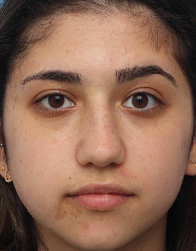 Rhinoplasty  Before & After Gallery - Patient 391687 - Image 3