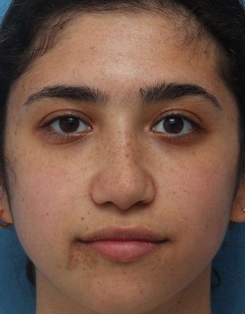 Rhinoplasty  Before & After Gallery - Patient 391687 - Image 4