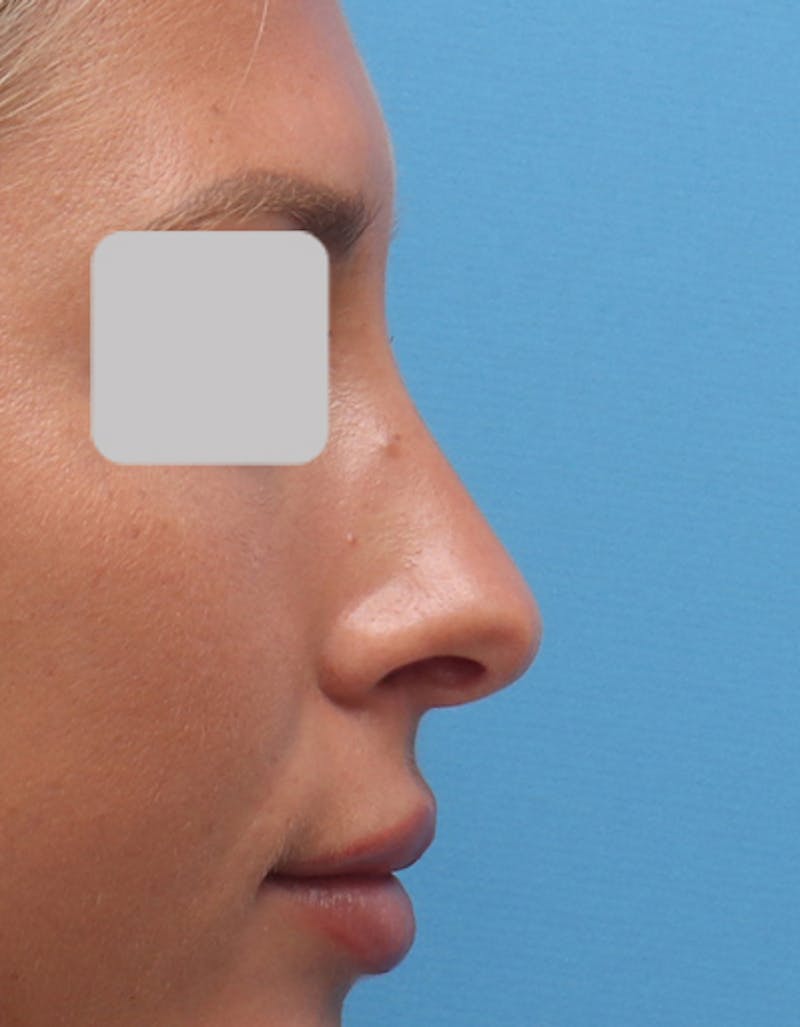 Rhinoplasty Before & After Gallery - Patient 334379 - Image 1