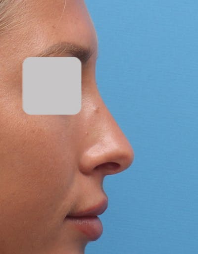 Rhinoplasty Before & After Gallery - Patient 150749 - Image 1