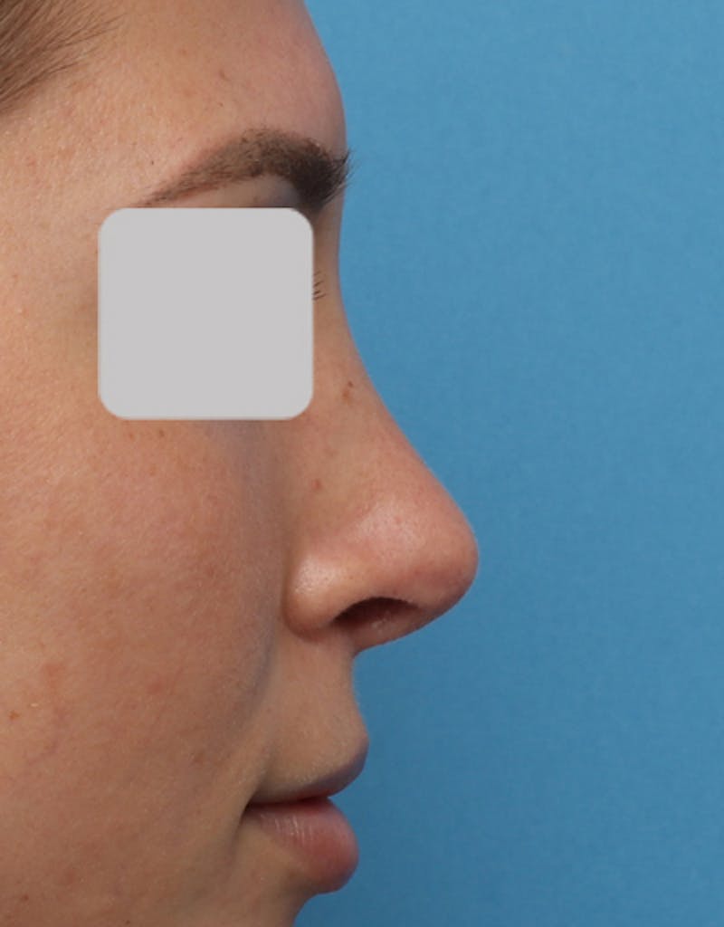 Rhinoplasty Before & After Gallery - Patient 334379 - Image 2