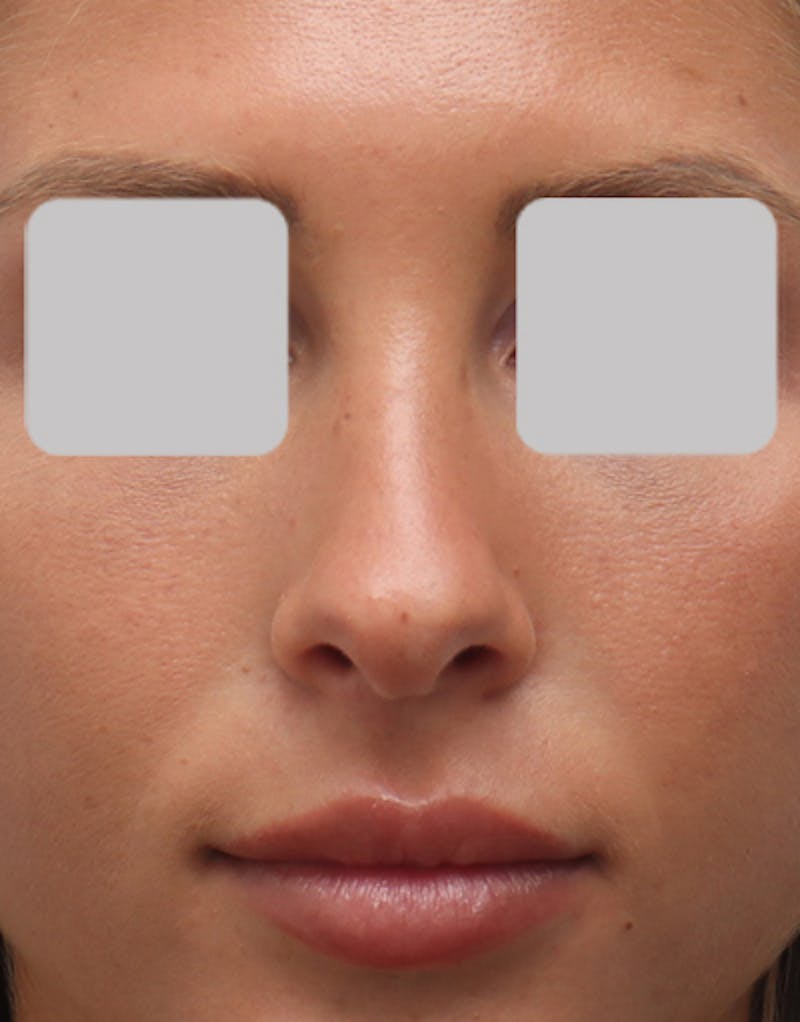 Rhinoplasty  Before & After Gallery - Patient 150749 - Image 3