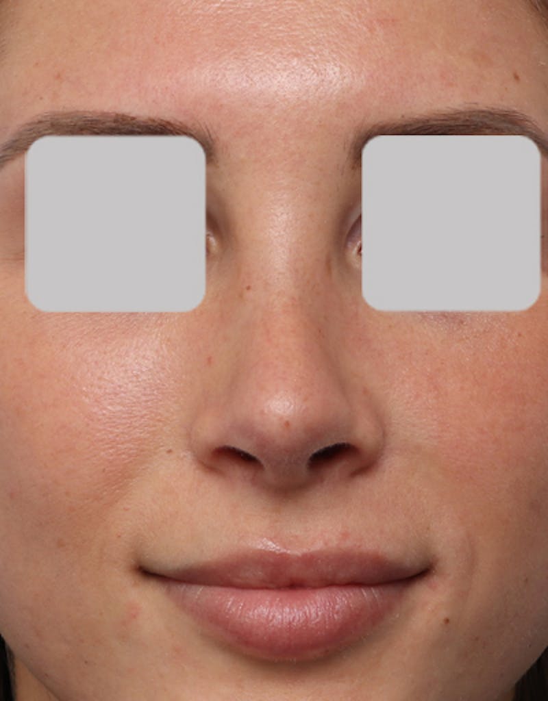Rhinoplasty  Before & After Gallery - Patient 150749 - Image 4