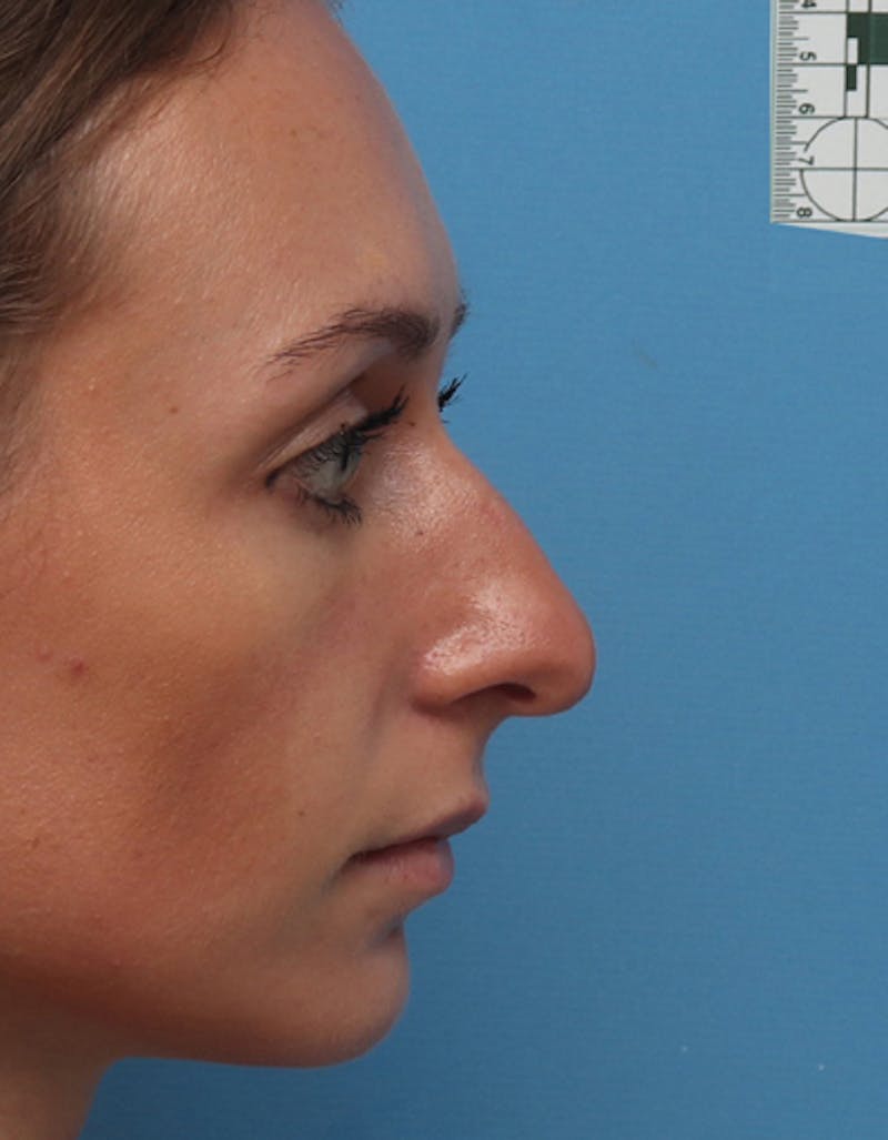 Patient Gk5Uua11RMGE3o0NWePgsg - Rhinoplasty Before & After Photos