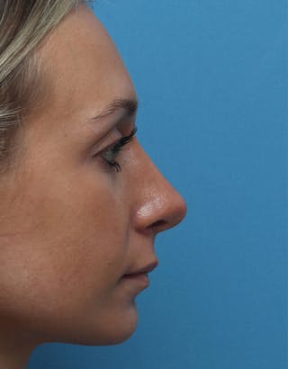 Rhinoplasty Before & After Gallery - Patient 102890 - Image 2