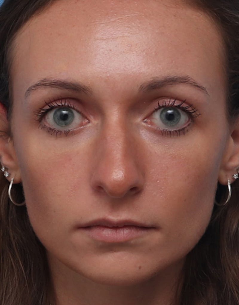 Rhinoplasty Before & After Gallery - Patient 658049 - Image 3