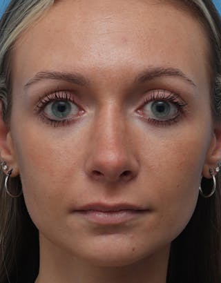 Rhinoplasty Before & After Gallery - Patient 102890 - Image 4