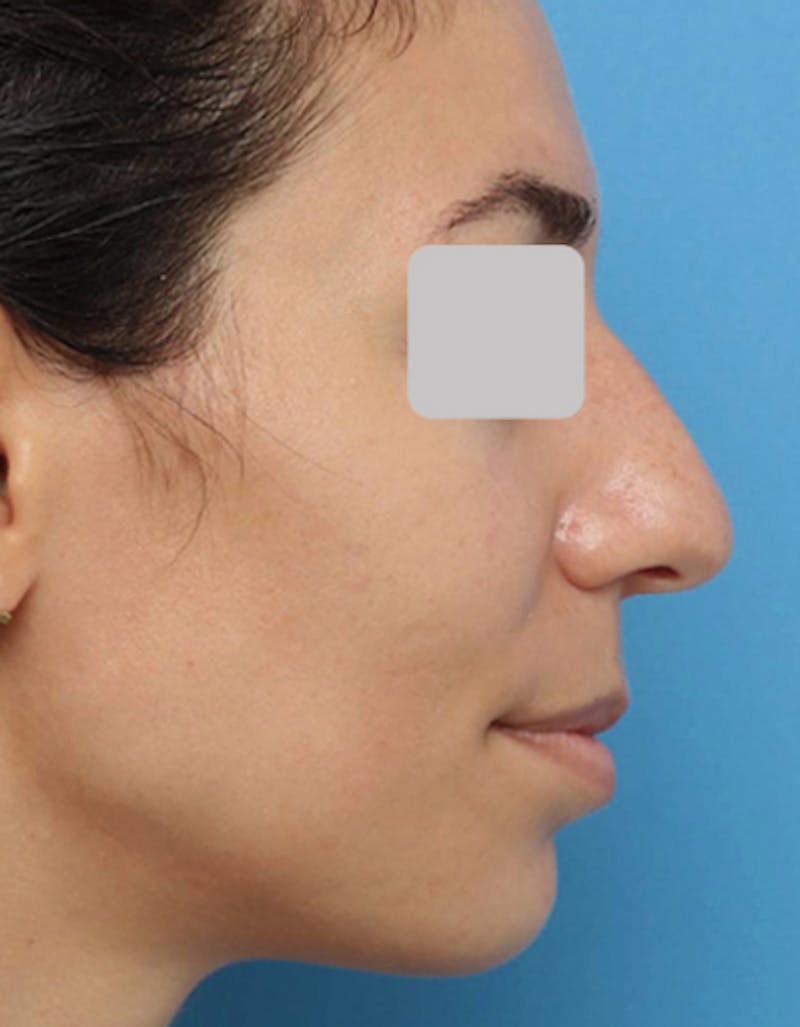 Rhinoplasty Before & After Gallery - Patient 710822 - Image 1