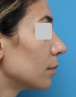 Rhinoplasty Before & After Gallery - Patient 292918 - Image 2