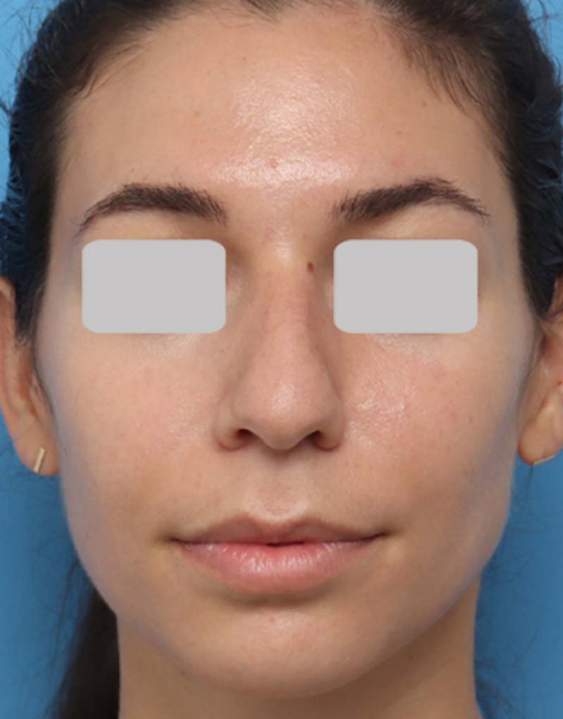 Rhinoplasty Before & After Gallery - Patient 710822 - Image 3