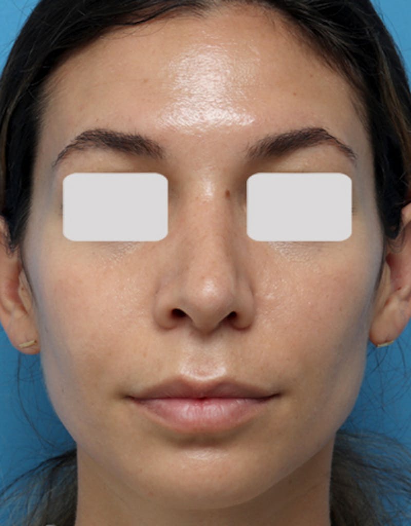 Rhinoplasty  Before & After Gallery - Patient 292918 - Image 4