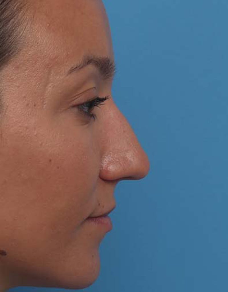 Patient GaXyhlyCR36EZ5safxPQLw - Rhinoplasty Before & After Photos