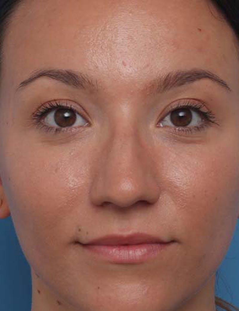 Rhinoplasty Before & After Gallery - Patient 414923 - Image 3
