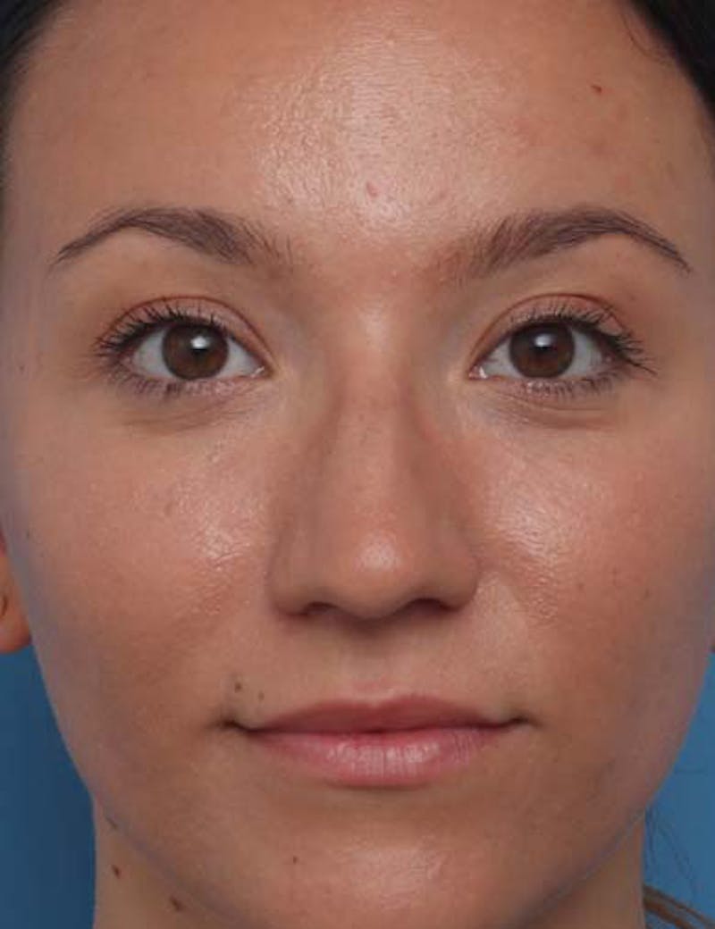 Rhinoplasty  Before & After Gallery - Patient 475746 - Image 3