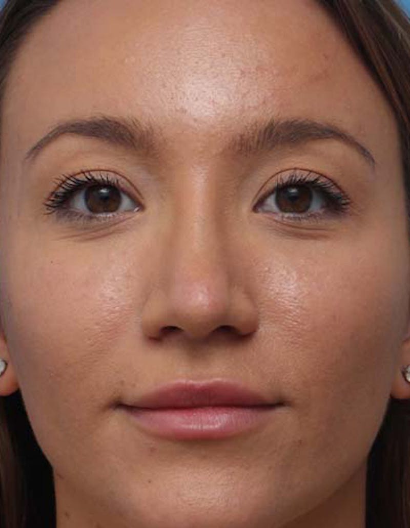 Rhinoplasty Before & After Gallery - Patient 414923 - Image 4