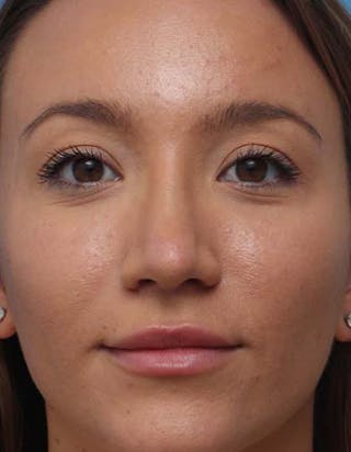 Rhinoplasty Before & After Gallery - Patient 475746 - Image 4