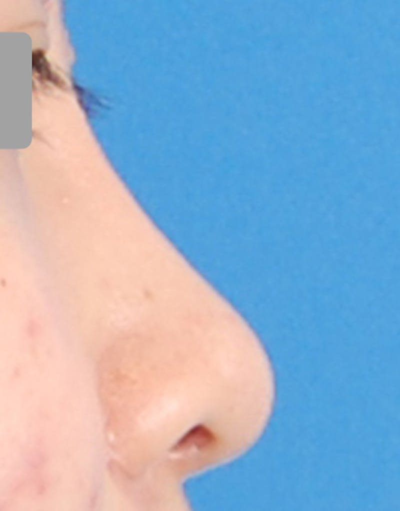 Rhinoplasty Before & After Gallery - Patient 385843 - Image 2