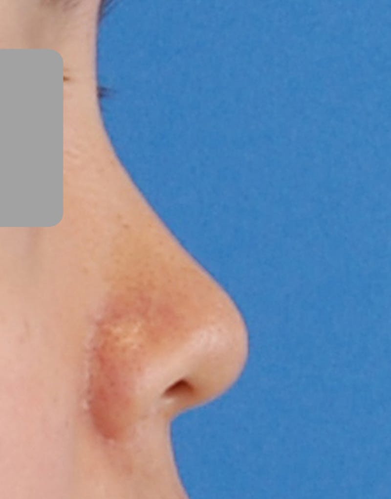 Patient X_4e2lr1QT-Lyah4R0H8kw - Rhinoplasty Before & After Photos