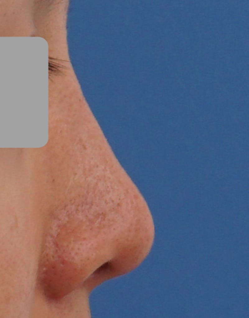 Rhinoplasty Before & After Gallery - Patient 385843 - Image 4