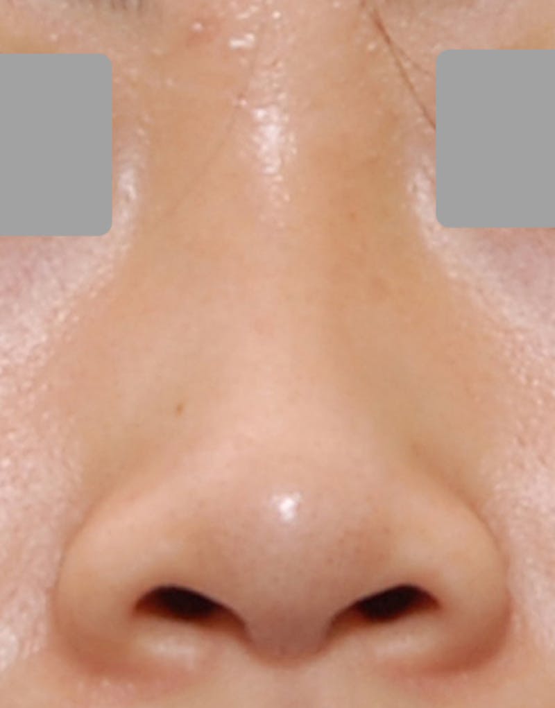 Rhinoplasty Before & After Gallery - Patient 385843 - Image 5