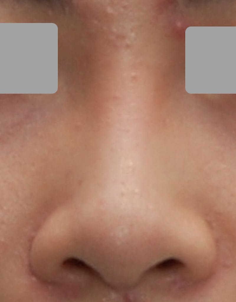 Rhinoplasty Before & After Gallery - Patient 385843 - Image 6