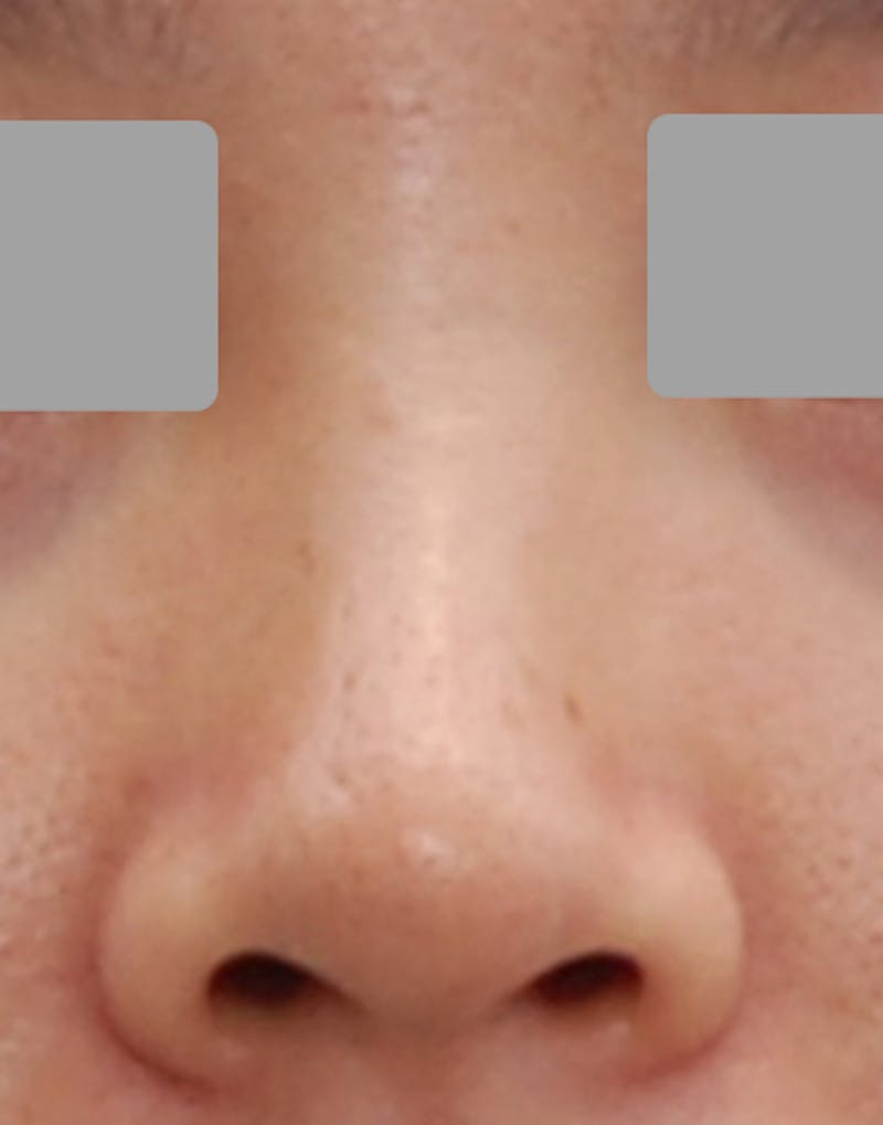 Rhinoplasty Before & After Gallery - Patient 385843 - Image 7