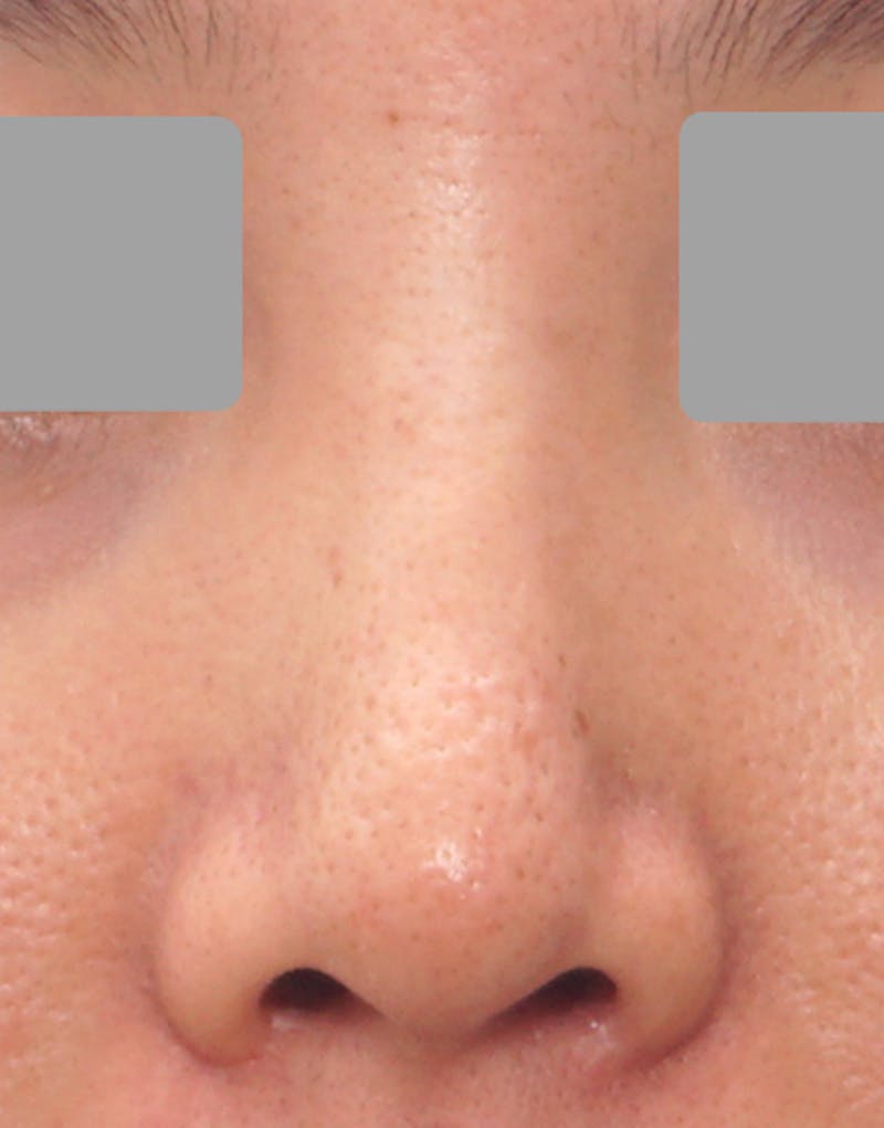 Rhinoplasty Before & After Gallery - Patient 385843 - Image 8