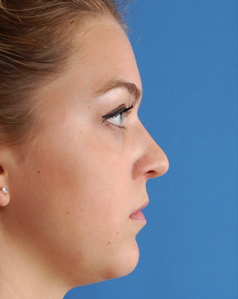 Rhinoplasty Before & After Gallery - Patient 374876 - Image 1