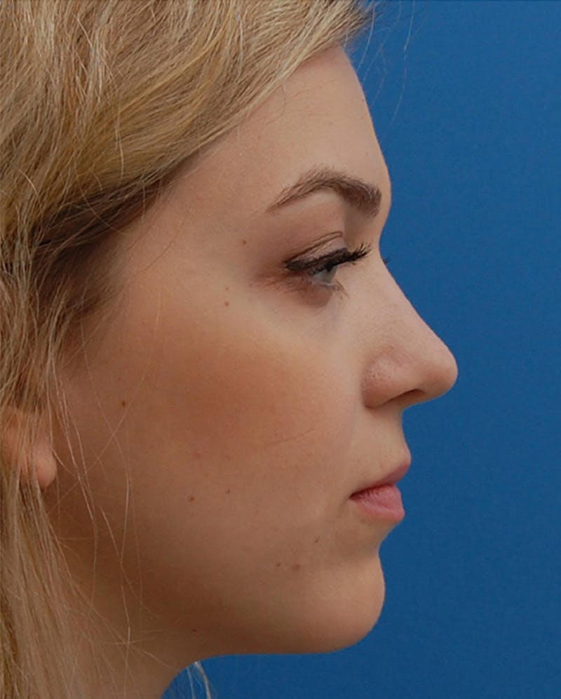 Rhinoplasty Before & After Gallery - Patient 374876 - Image 2