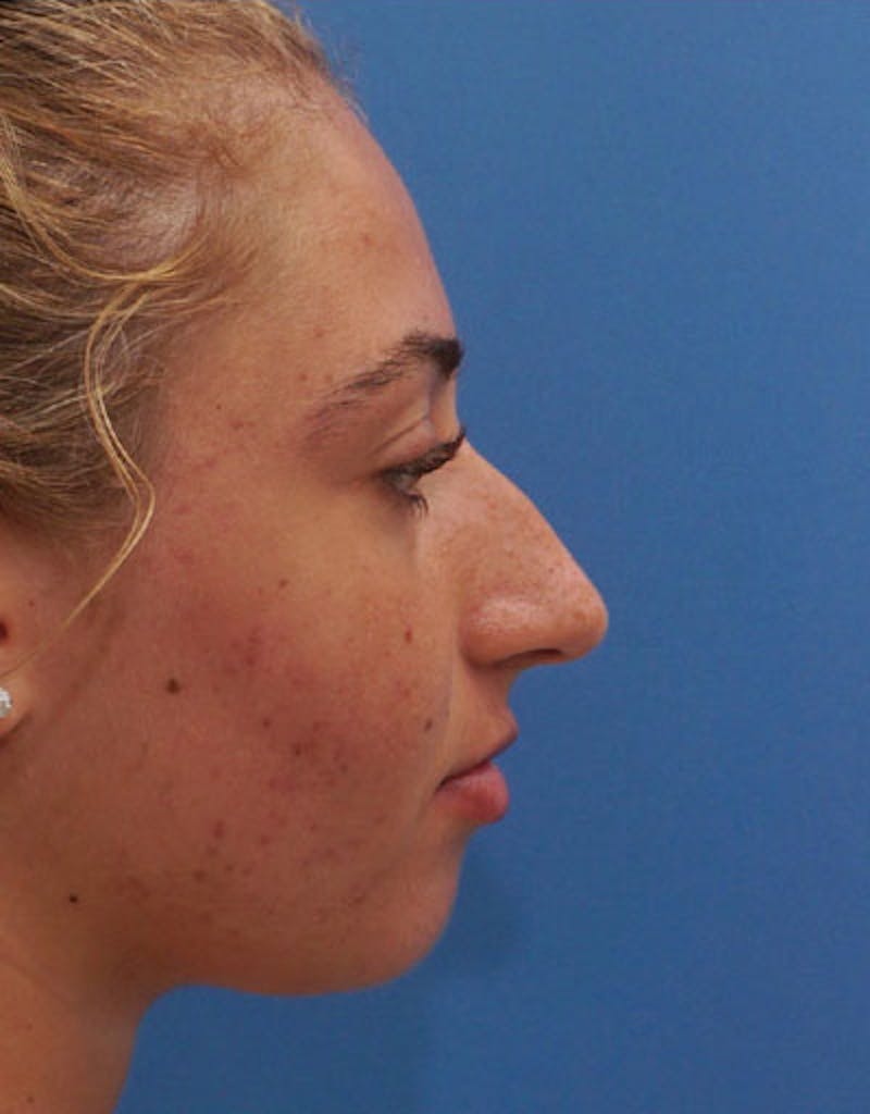 Patient YFuxWs6jQIeLD6925bLBkQ - Rhinoplasty Before & After Photos