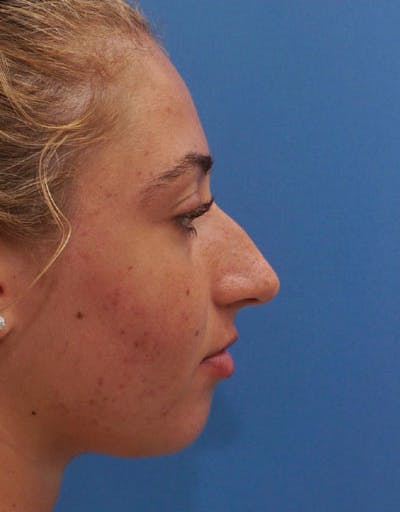 Rhinoplasty Before & After Gallery - Patient 100357 - Image 1