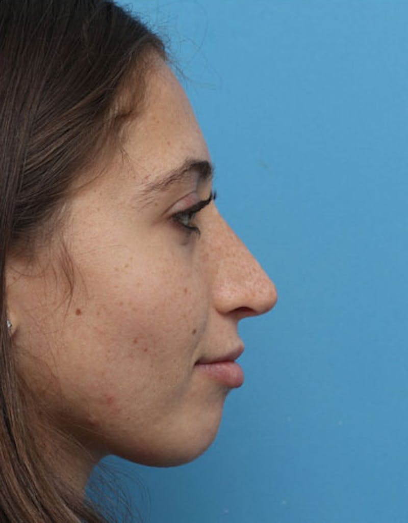 Rhinoplasty Before & After Gallery - Patient 250546 - Image 2