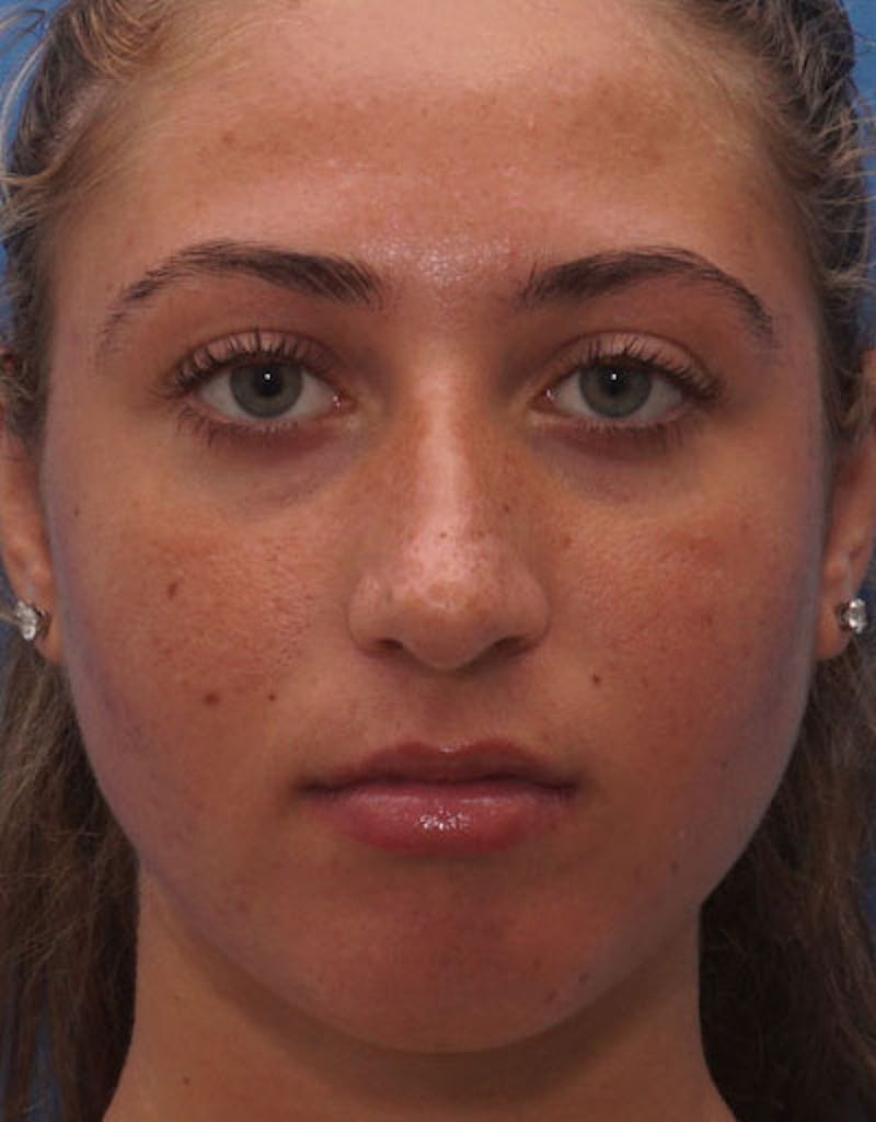 Rhinoplasty Before & After Gallery - Patient 250546 - Image 3