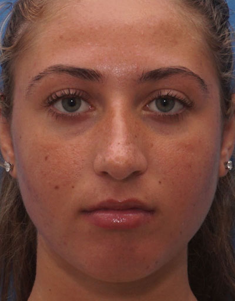 Rhinoplasty  Before & After Gallery - Patient 100357 - Image 3