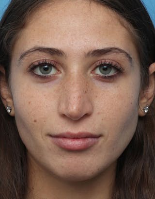 Rhinoplasty Before & After Gallery - Patient 100357 - Image 4