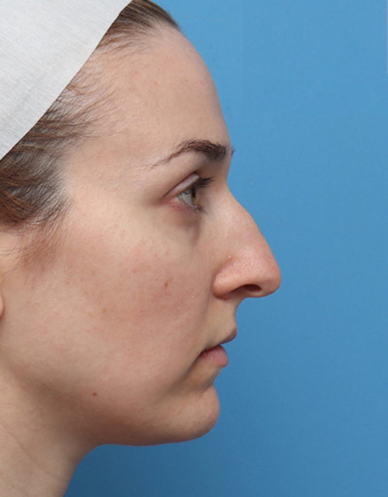 Rhinoplasty Before & After Gallery - Patient 305743 - Image 1