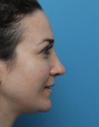 Rhinoplasty Before & After Gallery - Patient 168214 - Image 2