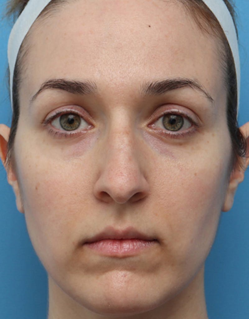 Rhinoplasty Before & After Gallery - Patient 305743 - Image 3