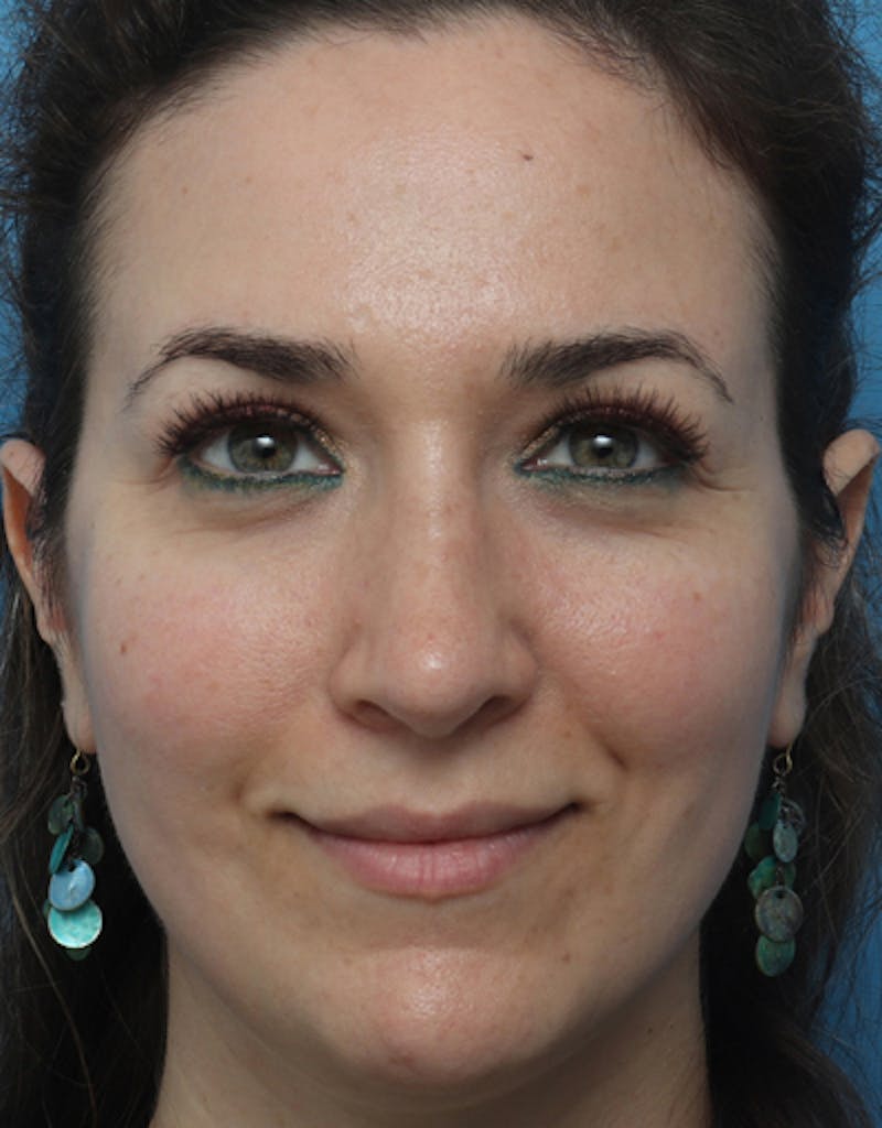 Rhinoplasty Before & After Gallery - Patient 305743 - Image 4