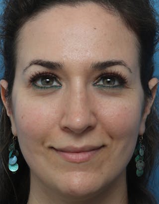 Rhinoplasty Before & After Gallery - Patient 168214 - Image 4