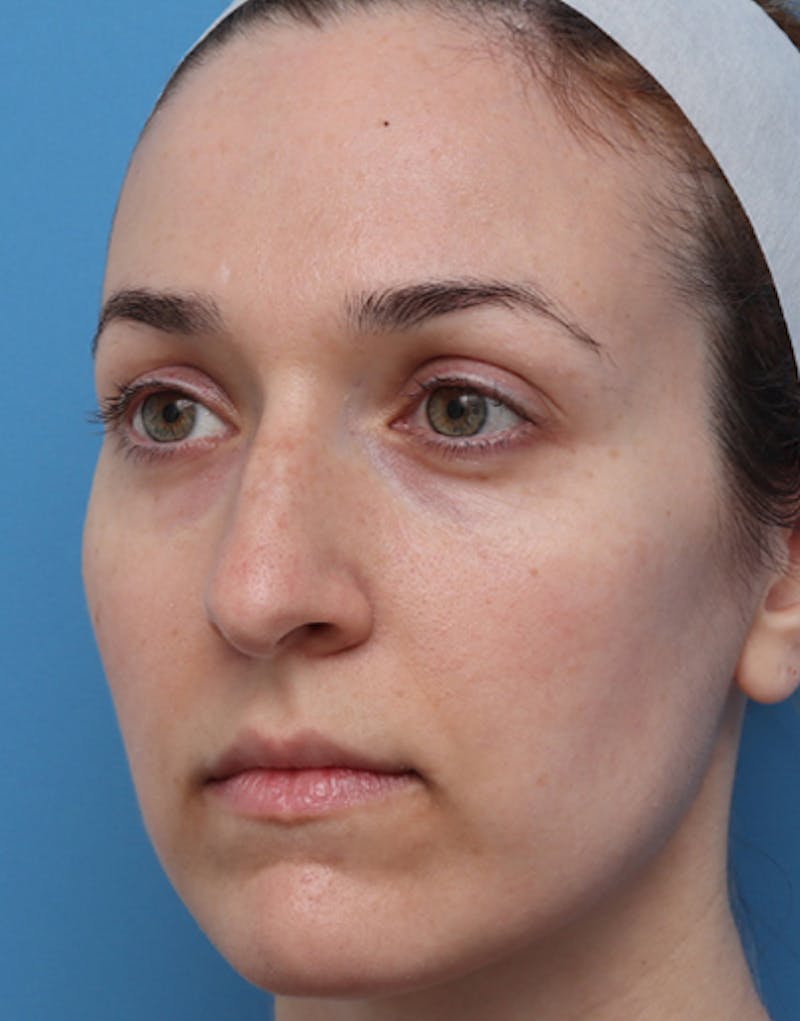 Rhinoplasty Before & After Gallery - Patient 305743 - Image 5