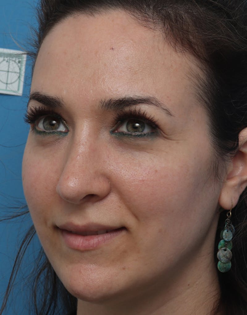 Rhinoplasty  Before & After Gallery - Patient 168214 - Image 6