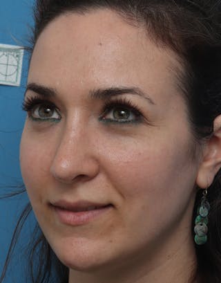 Rhinoplasty Before & After Gallery - Patient 168214 - Image 6