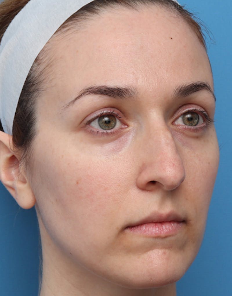 Rhinoplasty Before & After Gallery - Patient 305743 - Image 7