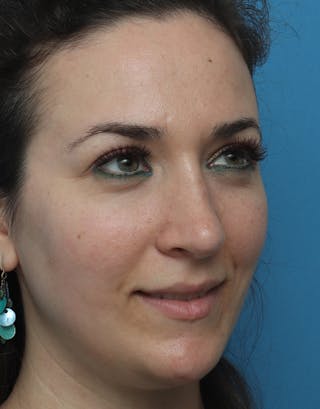 Rhinoplasty Before & After Gallery - Patient 168214 - Image 8