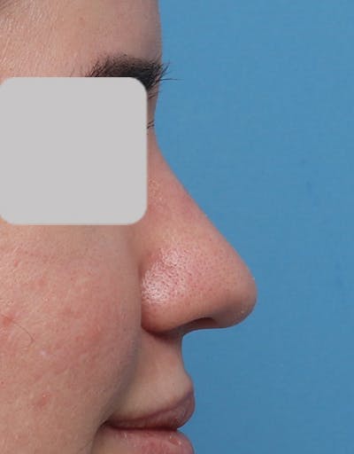 Rhinoplasty Before & After Gallery - Patient 323363 - Image 1