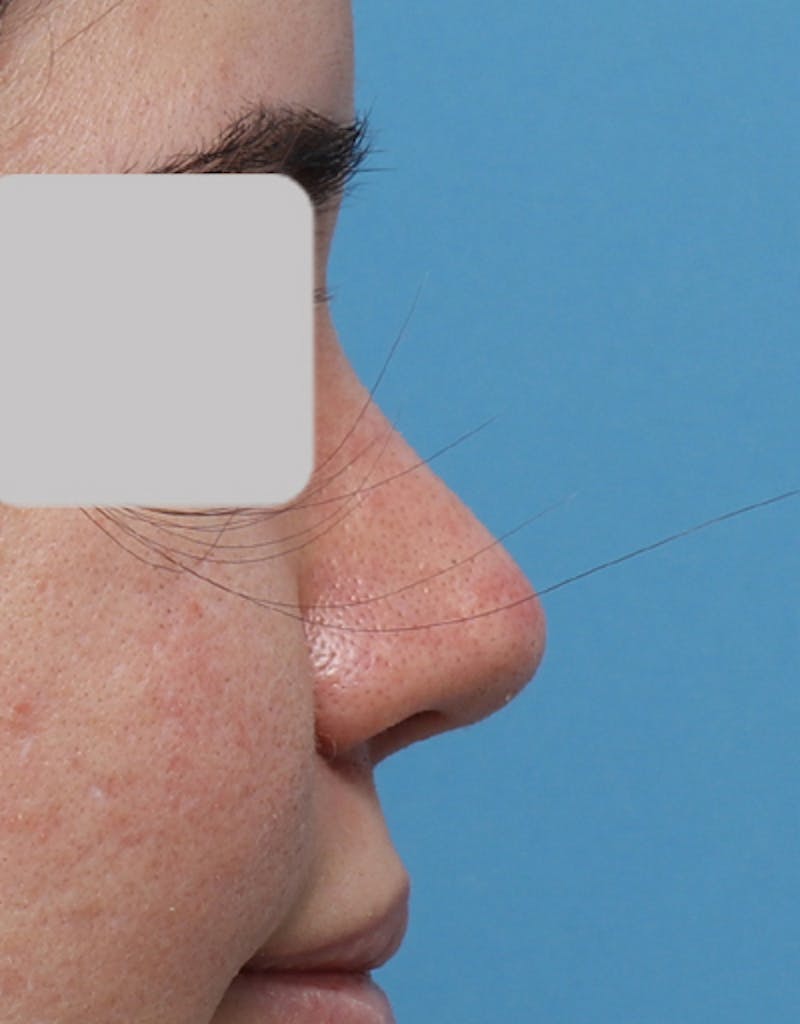 Rhinoplasty Before & After Gallery - Patient 181142 - Image 2