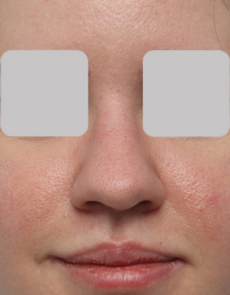 Rhinoplasty Before & After Gallery - Patient 181142 - Image 3