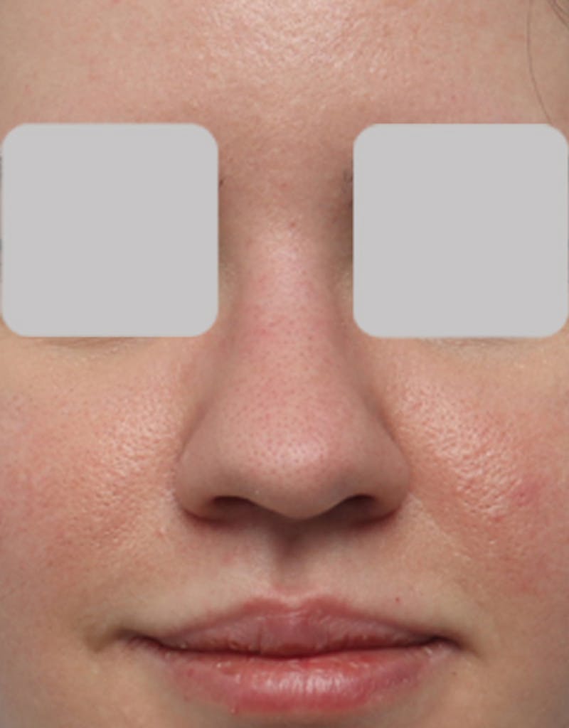 Rhinoplasty  Before & After Gallery - Patient 323363 - Image 3